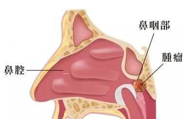 台湾进行质子治疗咽喉癌