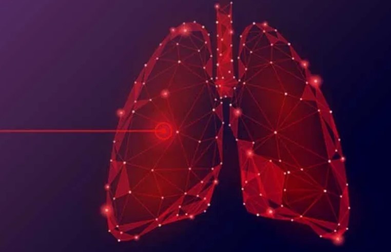 肺腺癌正確診斷、分型超關鍵！胸腔科醫師完整解析