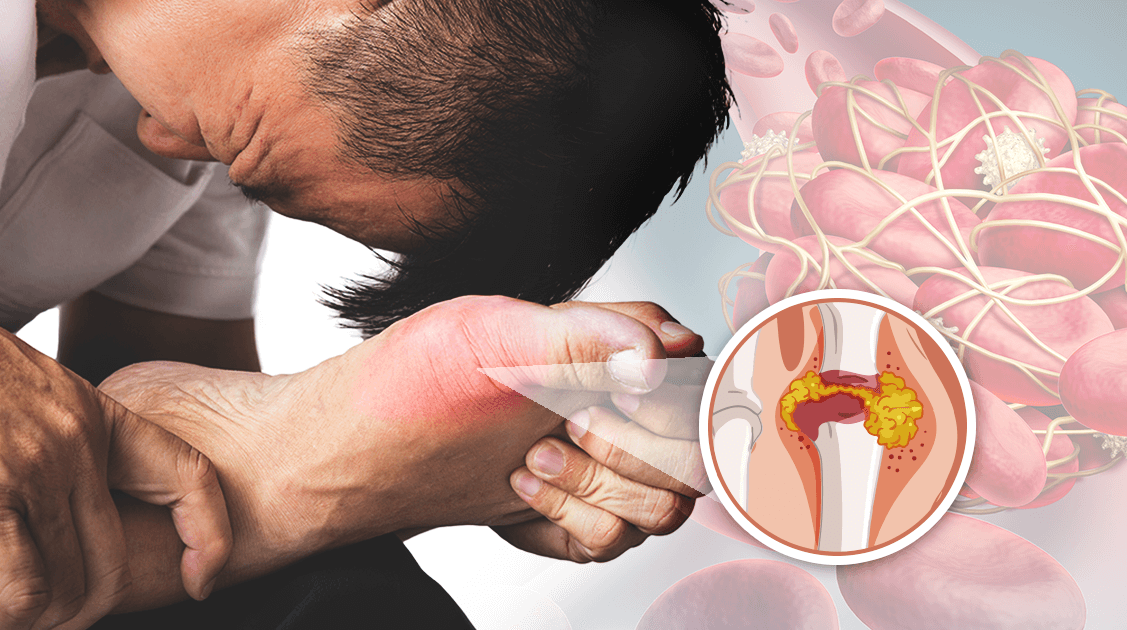 痛风发作乱吃降尿酸药