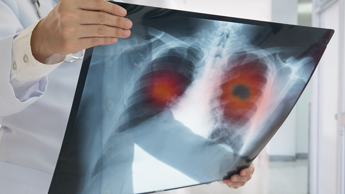肺癌早期發現是關鍵！臺大醫院醫師分析：你適合胸部X光檢查、計算機斷層還是低劑量計算機斷層？