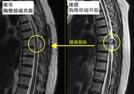 脊椎肿瘤