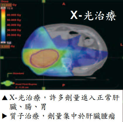 质子治疗杀肿瘤提高局部控制率