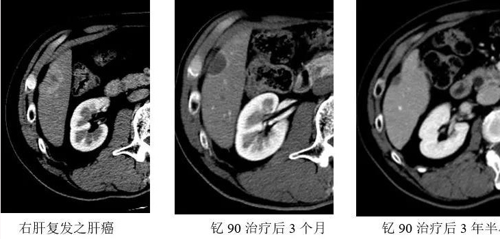 【台湾长庚医院】肝癌的动脉内治疗-钇90