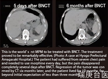 BNCT案例 | 恶性胸膜间皮瘤沿胸膜扩散