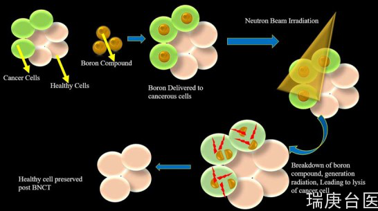 BNCT | 硼中子捕捉疗法治疗脊髓肿瘤