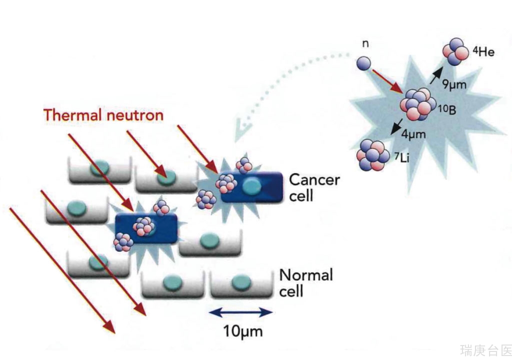 BNCT | 治疗脑癌的有效方法之一