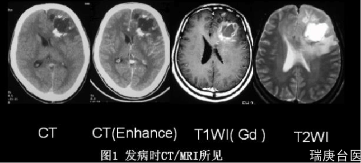 BNCT案例 | 胶质瘤术后复发硼中子捕获治疗