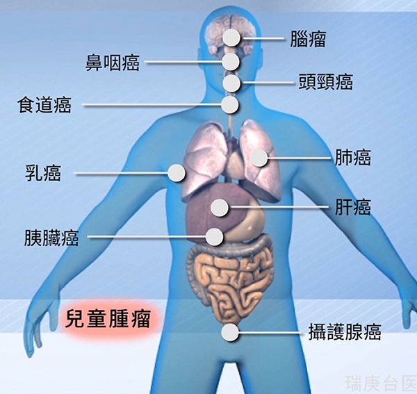 质子治疗案例 | 女孩患脑瘤，质子治疗让女孩正常成长