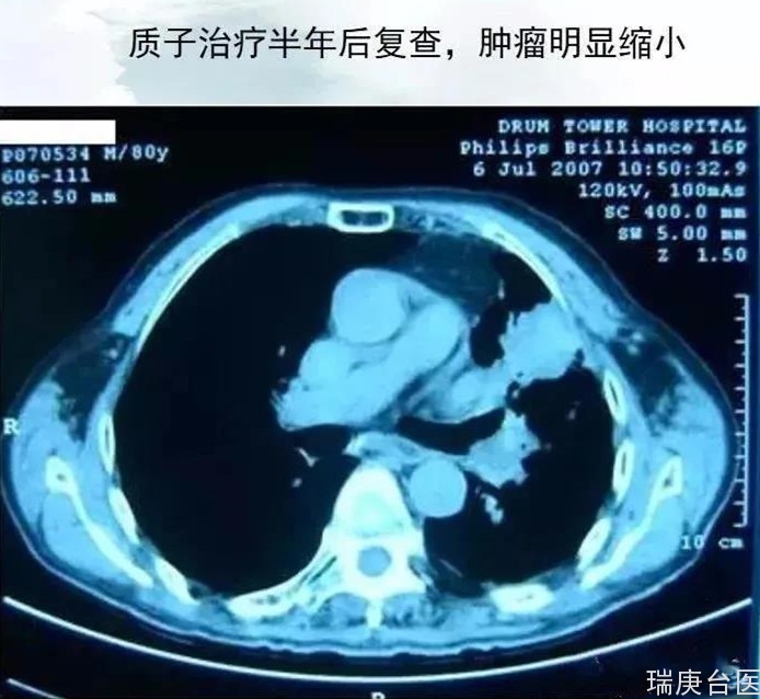 质子治疗 | 肺癌一年后复查病灶消失、局部纤维化15年未复发