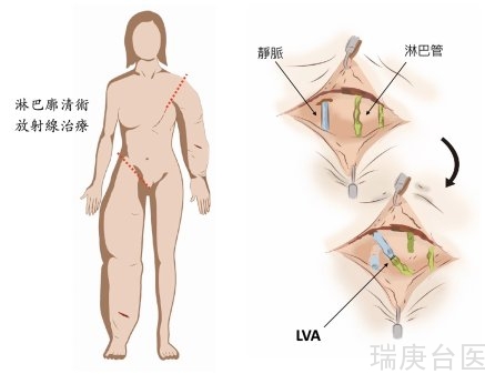 高雄长庚淋巴水肿中心超显微手术300例里程碑暨荣获国际淋巴水肿手术卓越中心认证