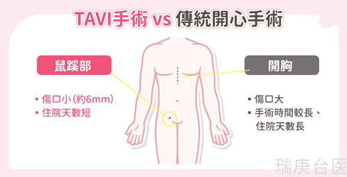 坐着也喘当心「严重主动脉瓣狭窄」！专家解析免开胸治疗方式解长辈心头患