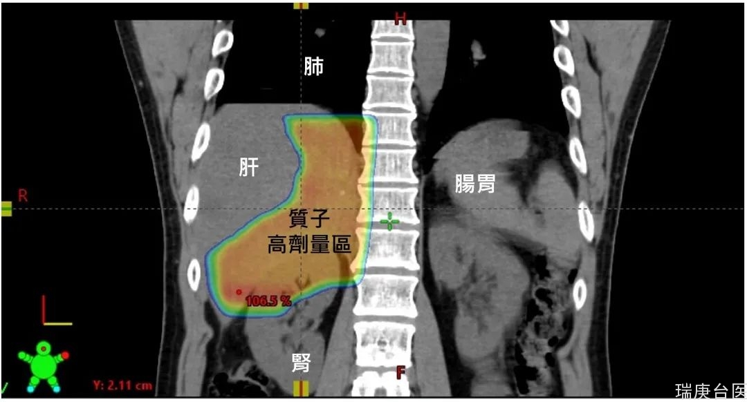 质子治疗案例分享 | 后腹腔巨大肉瘤新利器