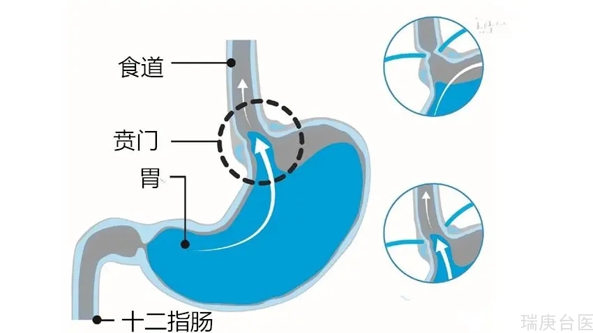 胃食道逆流久咳不愈常失声 小心是胃食道逆流