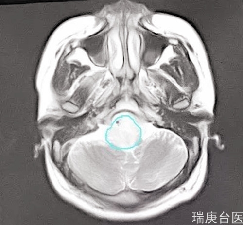 案例分享 | 质子治疗脑干胶质瘤的效果