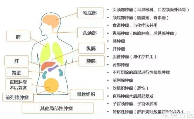 质子治疗脑膜瘤 | 肿瘤消失90%，3年无复发！