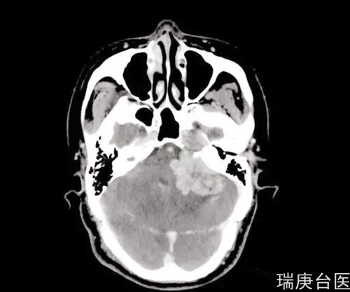 案例分享 | 血管周细胞瘤复发，质子治疗肿瘤较治疗前明显缩小