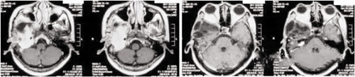 WHOⅢ級腦膜瘤 | 質子治療腫瘤縮小、壞死明顯