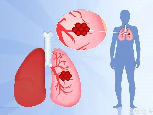 質子治療 | 質子對肺鱗癌結節根治性治療