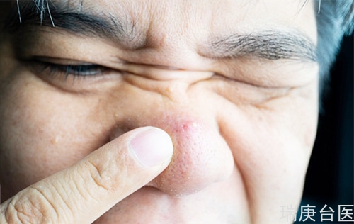 鼻子有個痘痘消不掉 沒想到是罕見鼻淋巴癌侵襲