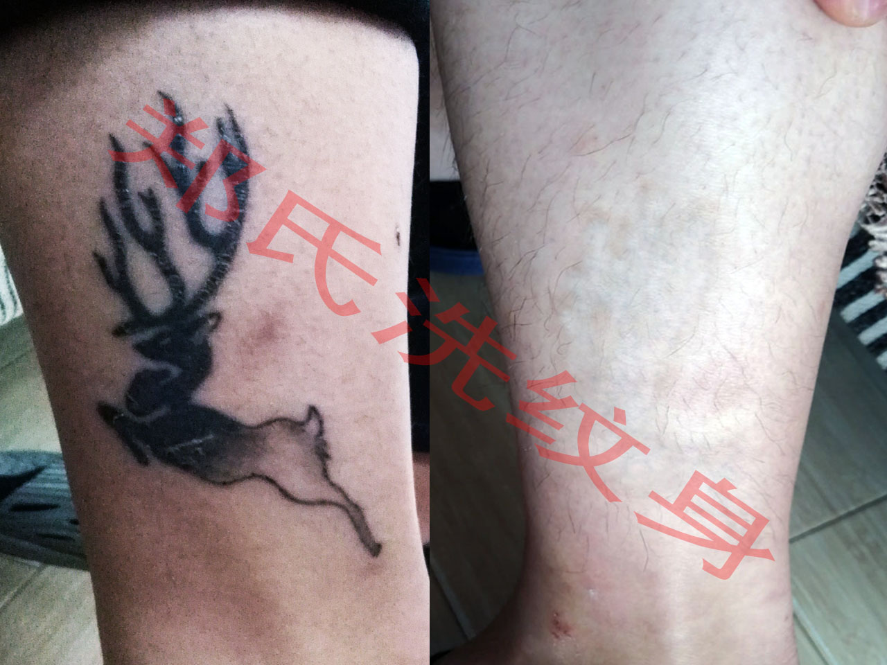 济南洗纹身